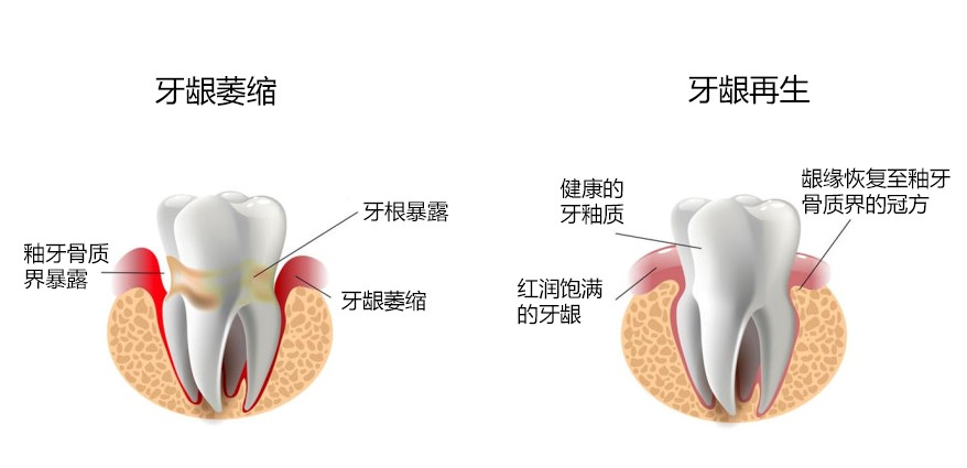 最新牙齦萎縮特效藥的研究與應(yīng)用